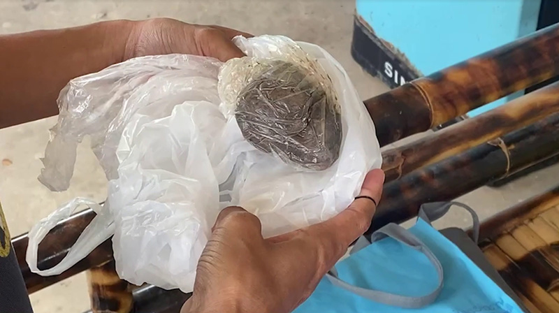  สาวคลอดลูก หมอลืมผ้าก๊อซทิ้งไว้ในช่องคลอด