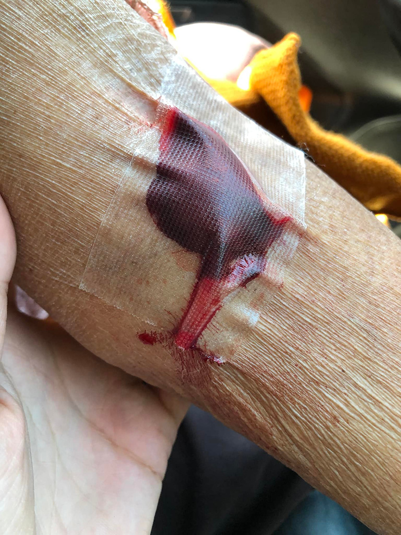 หลานทนมา 2 ปี ยายเจอพยาบาลด่า ล่าสุดเลือดไหลไม่หยุด