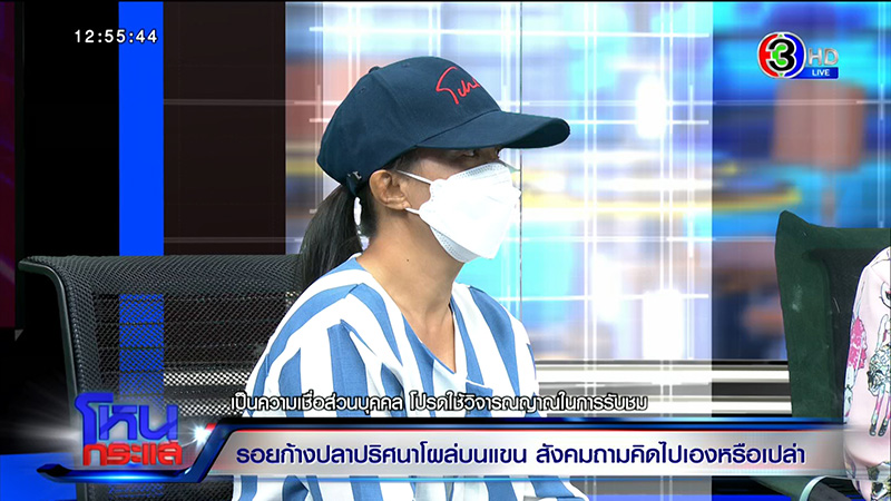 รอยก้างปลาปริศนาโผล่ที่แขน ด.ญ. วัย 13