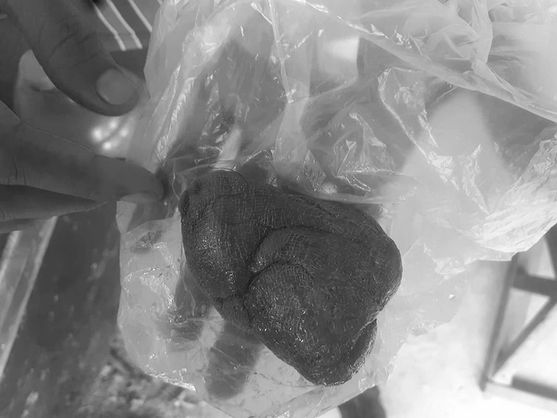  สาวคลอดลูก หมอลืมผ้าก๊อซทิ้งไว้ในช่องคลอด