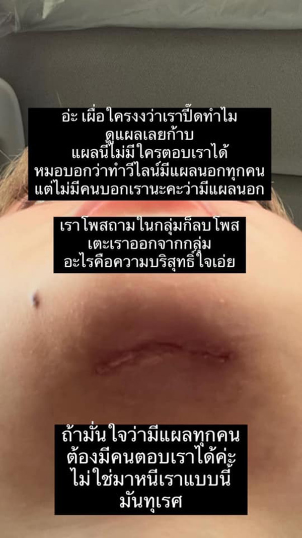 สาวทำคางวีไลน์ 2 แสน ผลออกมาคือตราบาป 