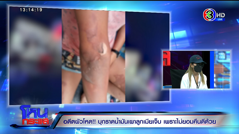 หญิงถูกสามีจุดไฟเผาต่อหน้าลูก เจ็บแต่ยังให้โอกาสคืนดี