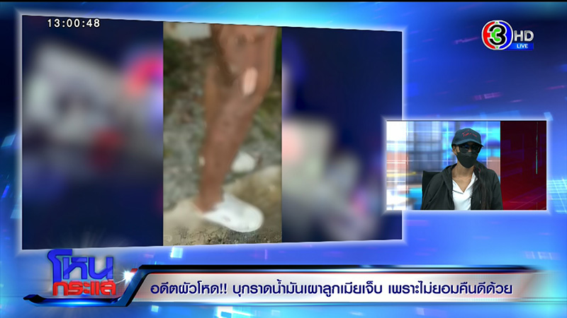 หญิงถูกสามีจุดไฟเผาต่อหน้าลูก เจ็บแต่ยังให้โอกาสคืนดี