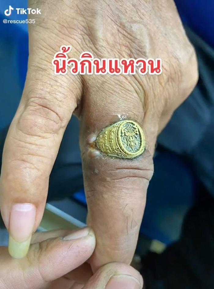 กู้ภัยเผยคลิปนาทีช่วยคนนิ้วกินแหวน