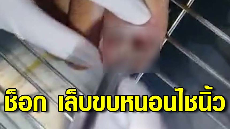 ชายเจ็บเล็บขบอักเสบจนนิ้วบวมเป่ง