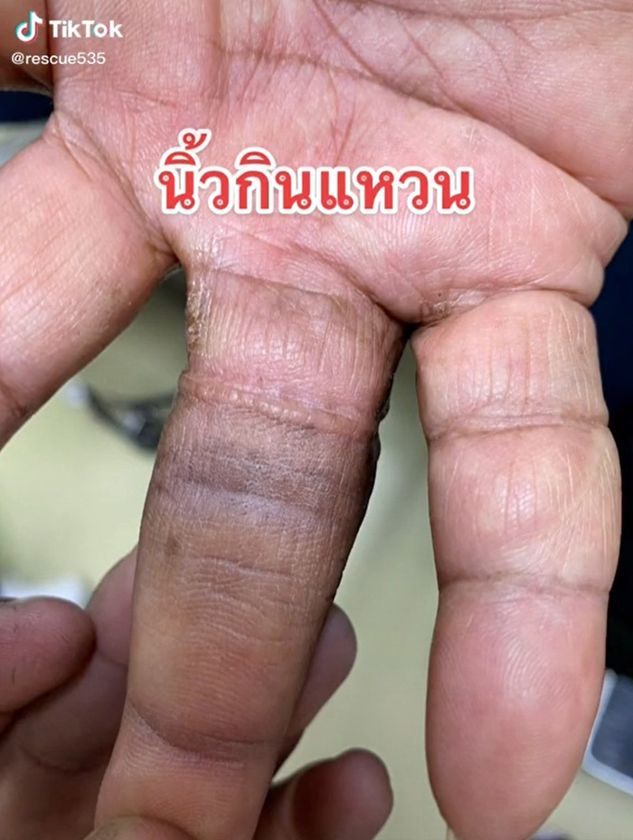 กู้ภัยเผยคลิปนาทีช่วยคนนิ้วกินแหวน