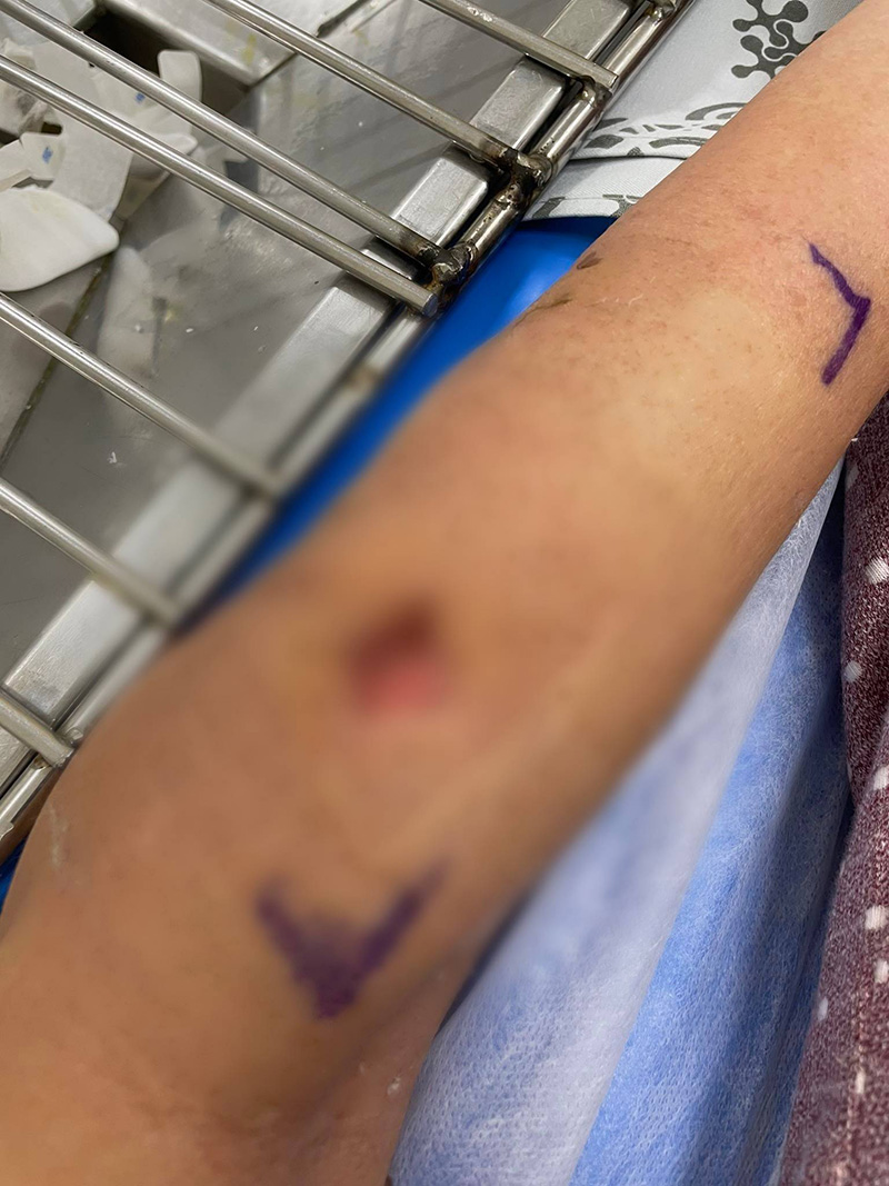 เตือนภัย ! นทท. โดนลิงเผือกเขาสามมุกกัดจมเขี้ยว