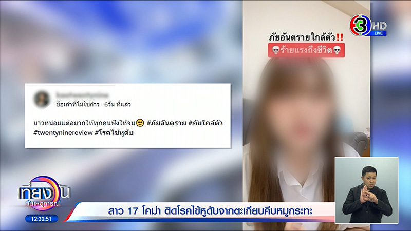 อุทาหรณ์สายปิ้งย่าง ใช้ตะเกียบคีบหมูกระทะ ป่วยไข้หูดับ เข้า ICU อาการโคม่า