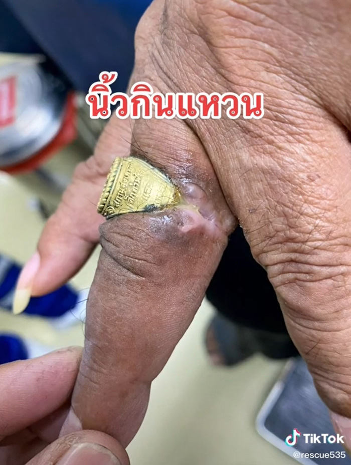 กู้ภัยเผยคลิปนาทีช่วยคนนิ้วกินแหวน