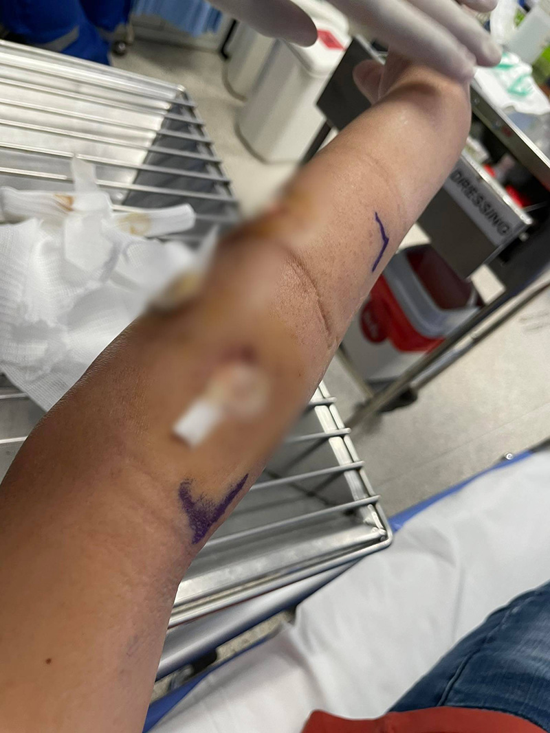 เตือนภัย ! นทท. โดนลิงเผือกเขาสามมุกกัดจมเขี้ยว