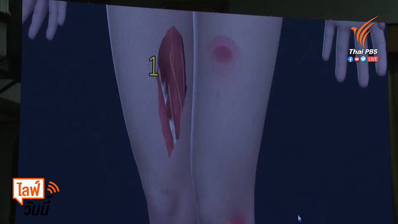 แผลแตงโม นิดา