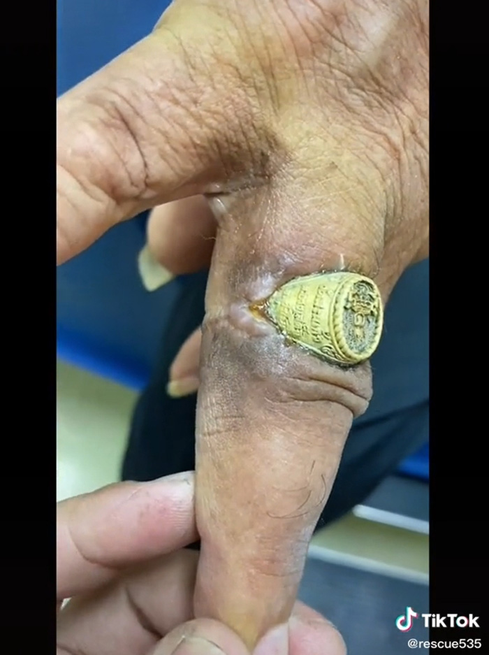 กู้ภัยเผยคลิปนาทีช่วยคนนิ้วกินแหวน