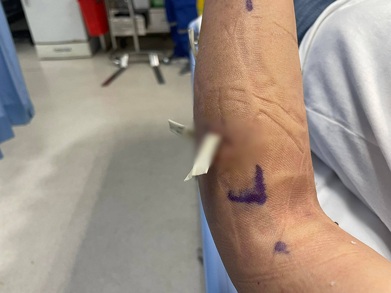 เตือนภัย ! นทท. โดนลิงเผือกเขาสามมุกกัดจมเขี้ยว