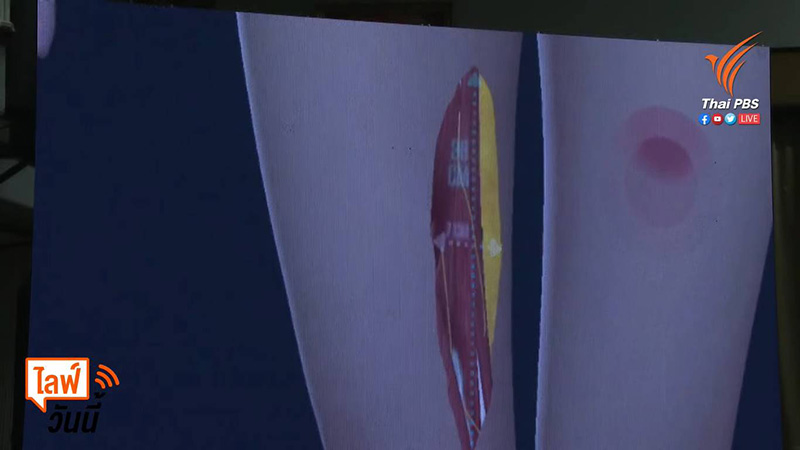 แผลแตงโม นิดา