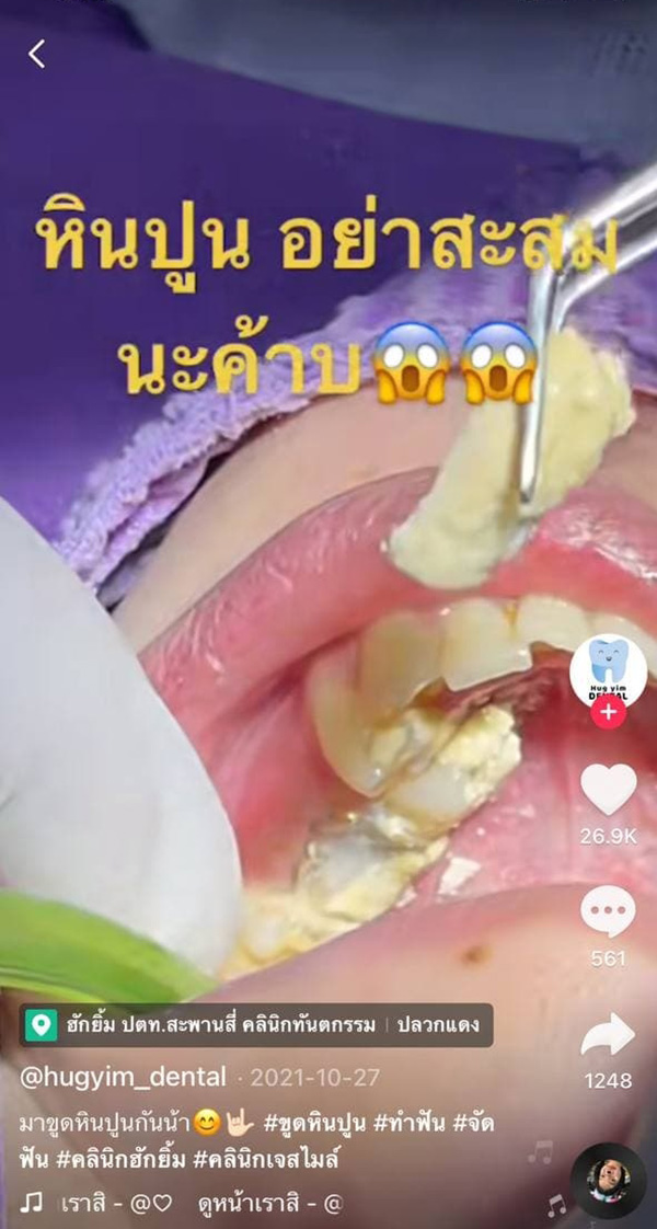 คลิปขูดหินปูนคนไข้ 