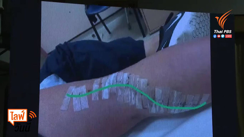 แผลแตงโม นิดา