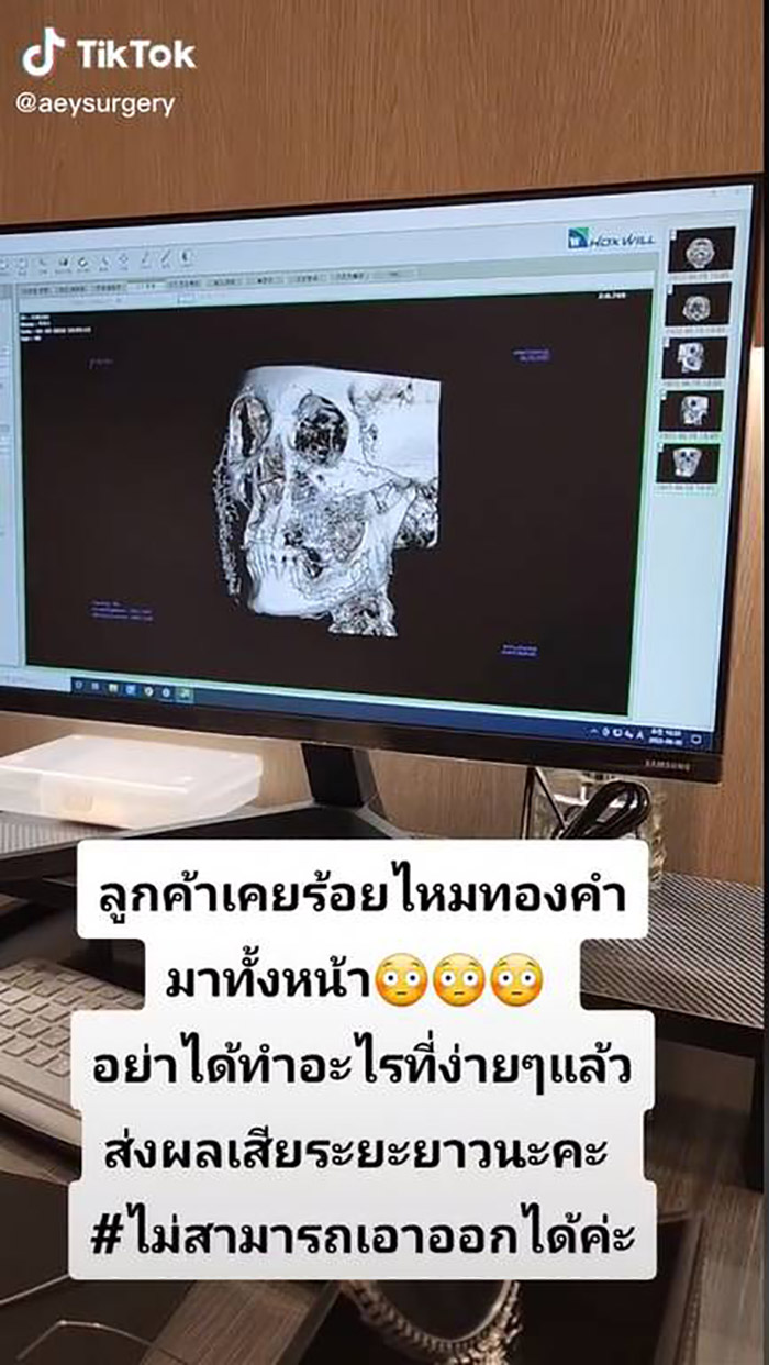 เปิดภาพสแกน 4D ร้อยไหมทองคำทั้งหน้า 