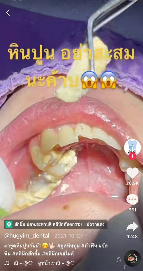 คลิปขูดหินปูนคนไข้ 