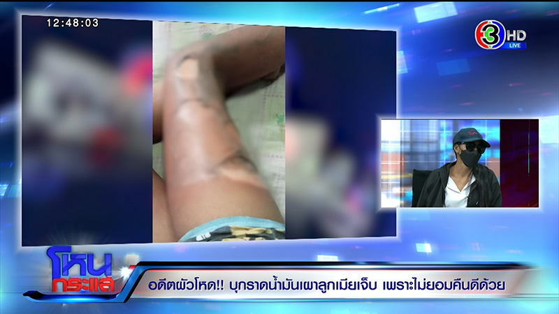 หญิงถูกสามีจุดไฟเผาต่อหน้าลูก เจ็บแต่ยังให้โอกาสคืนดี