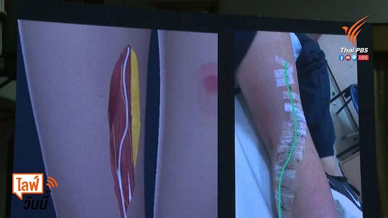 แผลแตงโม นิดา