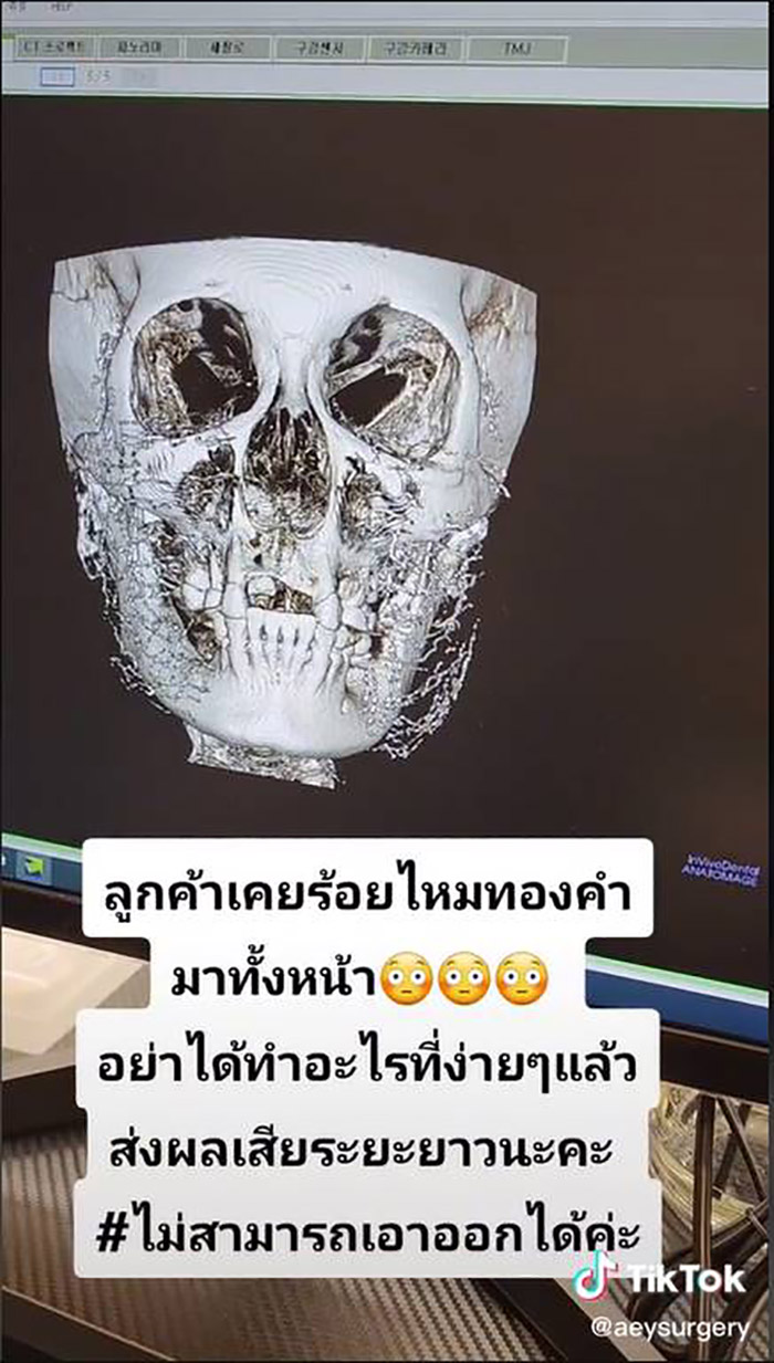 เปิดภาพสแกน 4D ร้อยไหมทองคำทั้งหน้า 