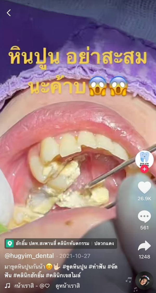 คลิปขูดหินปูนคนไข้ 