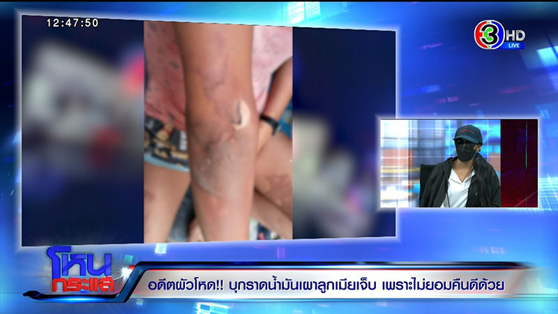 หญิงถูกสามีจุดไฟเผาต่อหน้าลูก เจ็บแต่ยังให้โอกาสคืนดี