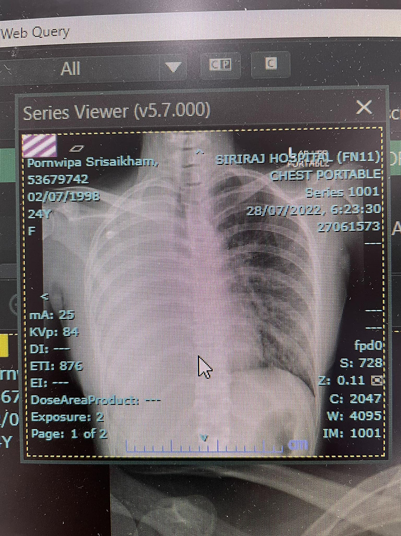 พยาบาลสาวอนาคตไกล แชร์ประสบการณ์ป่วยมะเร็งปอดระยะสุดท้าย 