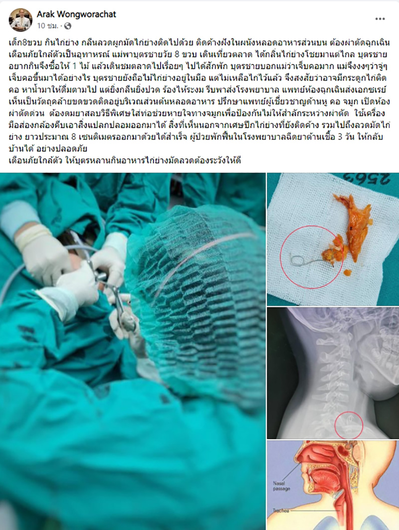 เด็ก 8 ขวบ เจ็บคอ หมออึ้ง เอกซเรย์เจอลวดมัดไก่ย่าง 8 ซม. 