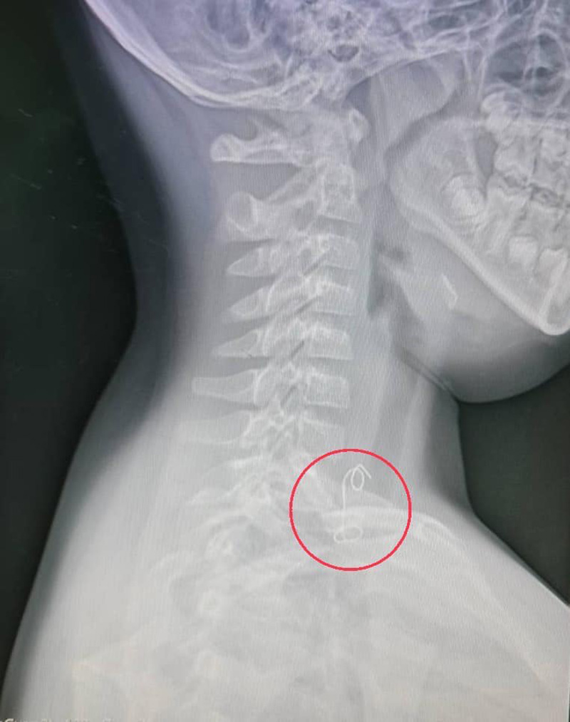 เด็ก 8 ขวบ เจ็บคอ หมออึ้ง เอกซเรย์เจอลวดมัดไก่ย่าง 8 ซม. 