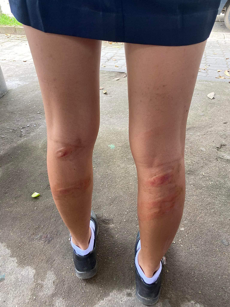 แม่เดือด เปิดภาพขาลูกหลังถูกครูตี