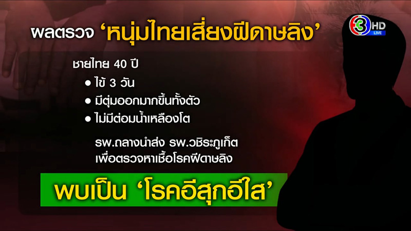 โรคอีสุกอีใส 