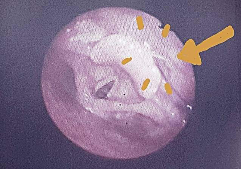 อุทาหรณ์ก้างปลาติดคอ หมอเตือนกลืนข้าวตามเป็นความเชื่อที่ผิด