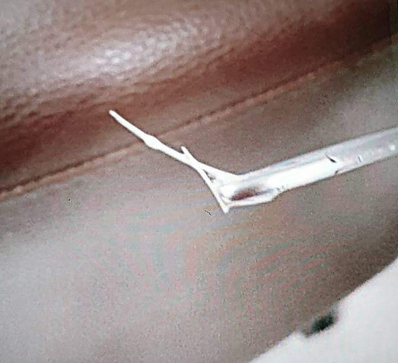 อุทาหรณ์ก้างปลาติดคอ หมอเตือนกลืนข้าวตามเป็นความเชื่อที่ผิด