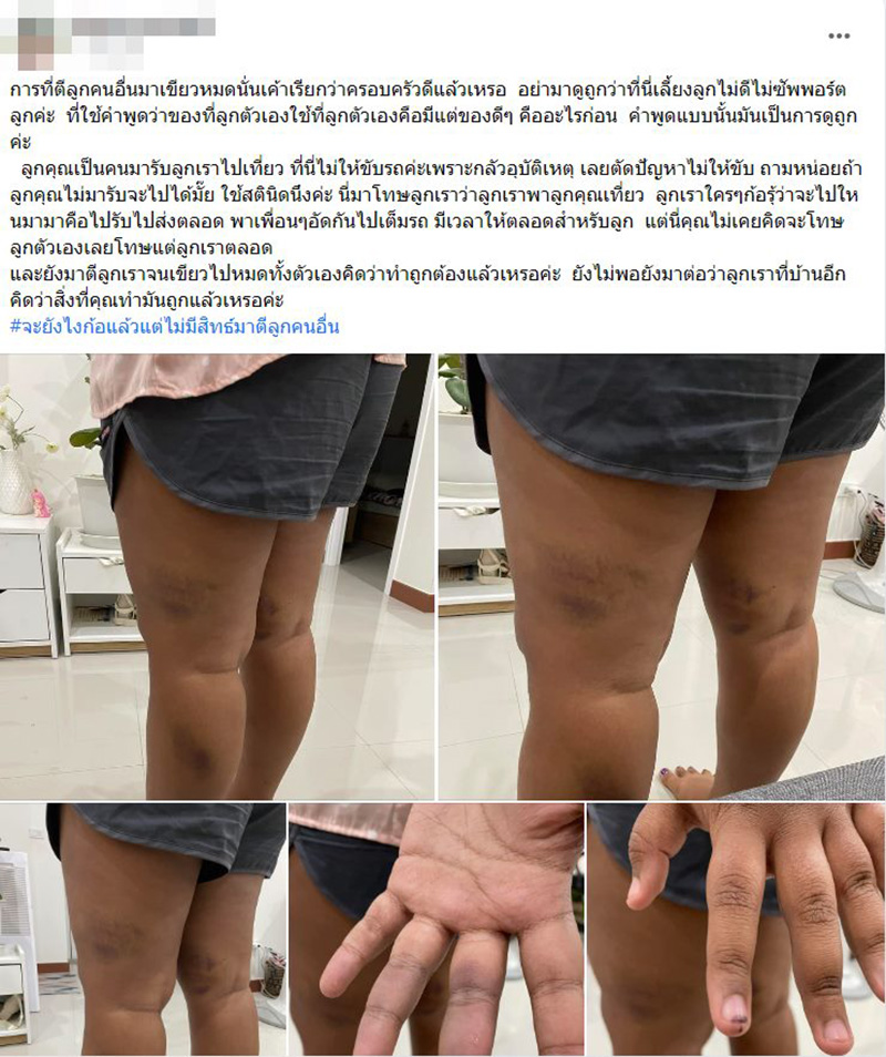 ลูกสาวถูกแม่เพื่อนตีจนเขียวช้ำ 