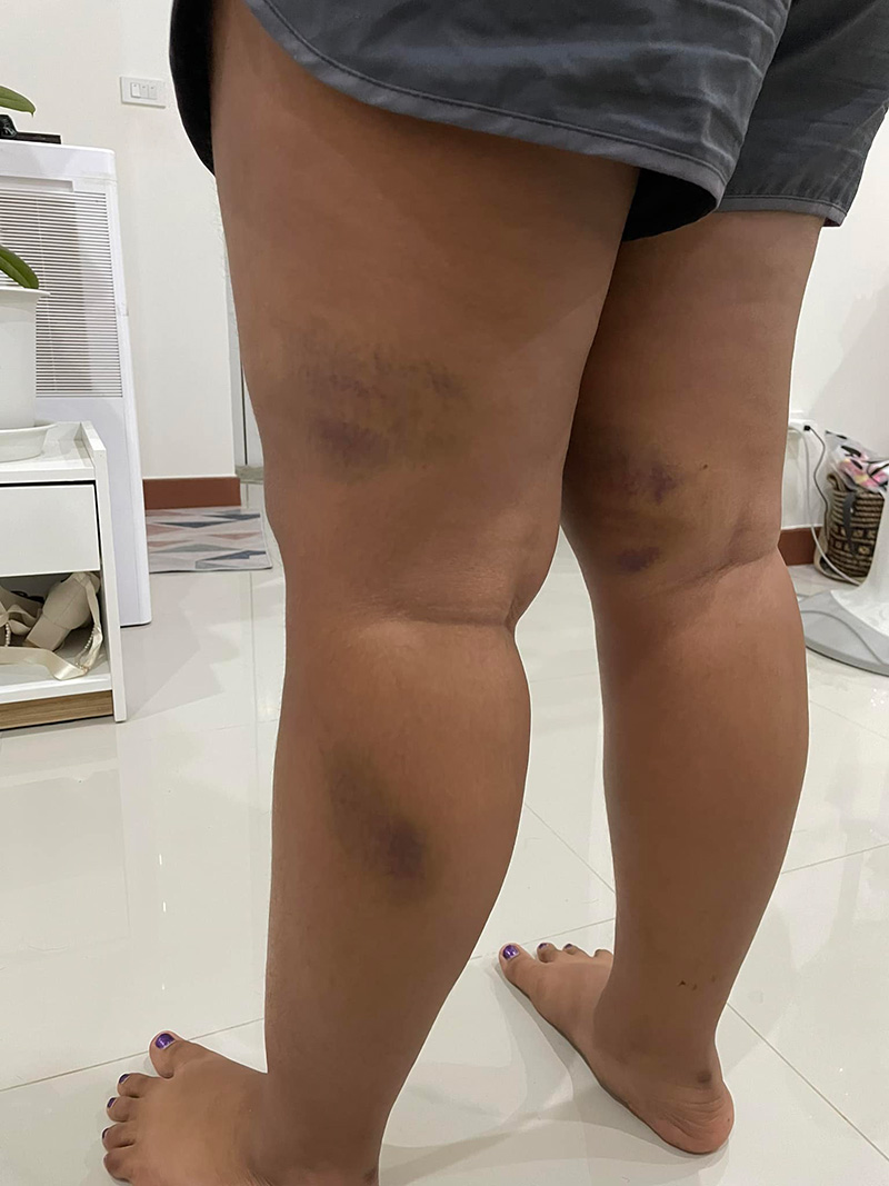 ลูกสาวถูกแม่เพื่อนตีจนเขียวช้ำ 