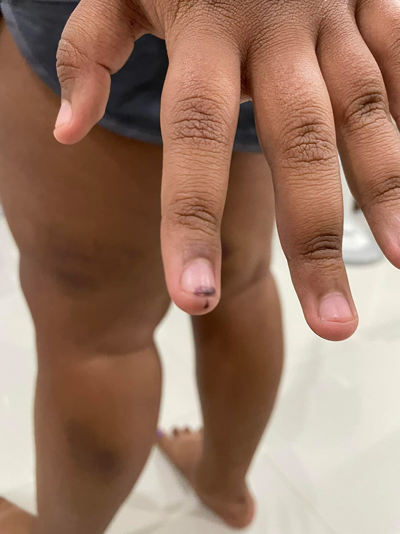 ลูกสาวถูกแม่เพื่อนตีจนเขียวช้ำ 