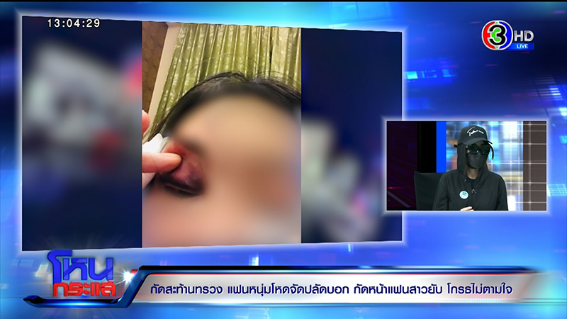 สาวโดนกัดหน้า VS แฟนเก่า