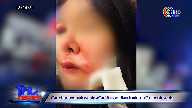 สาวโดนกัดหน้า VS แฟนเก่า