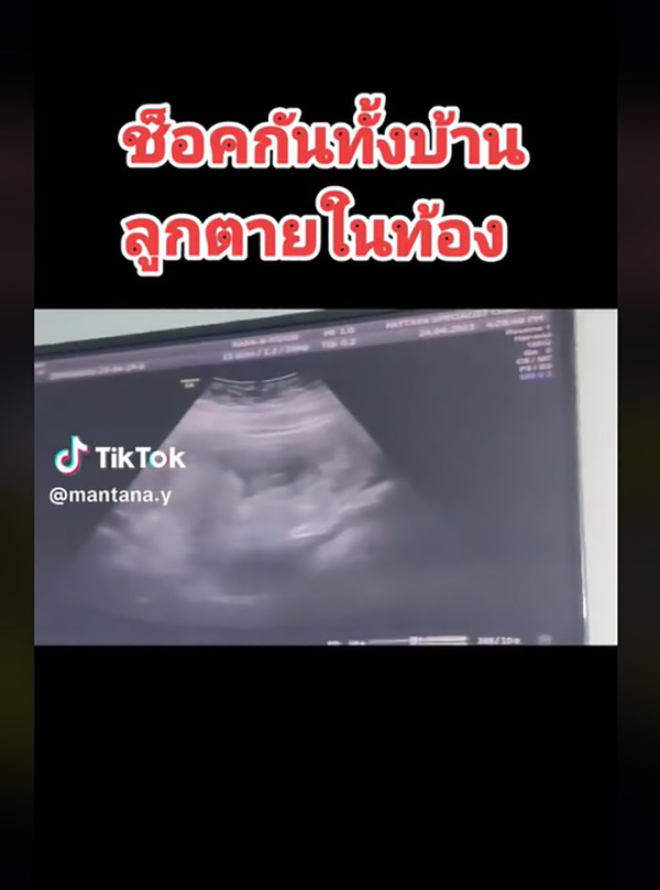 ฝันร้ายของแม่ทุกคน สาวไปตรวจครรภ์ อัลตราซาวด์แล้วลูกตายในท้อง