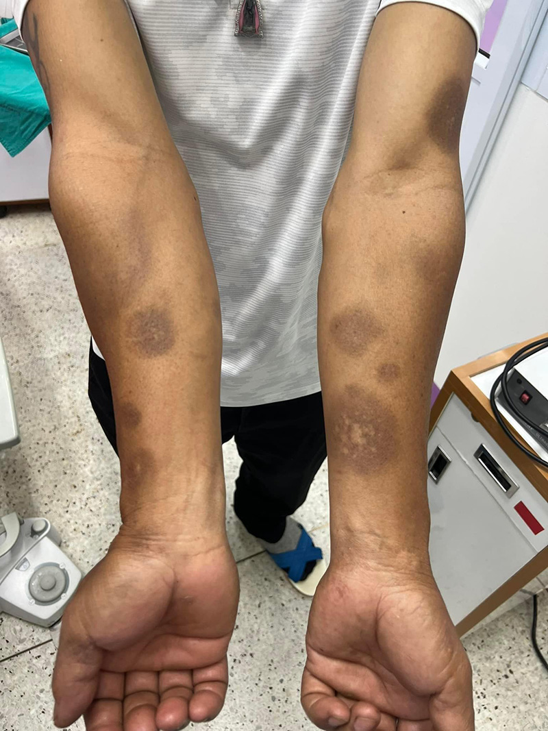  เจอเคสคนไข้มาทำฟัน พบจ้ำเลือดผิดปกติตามตัว ชี้อันตรายถึงชีวิต 