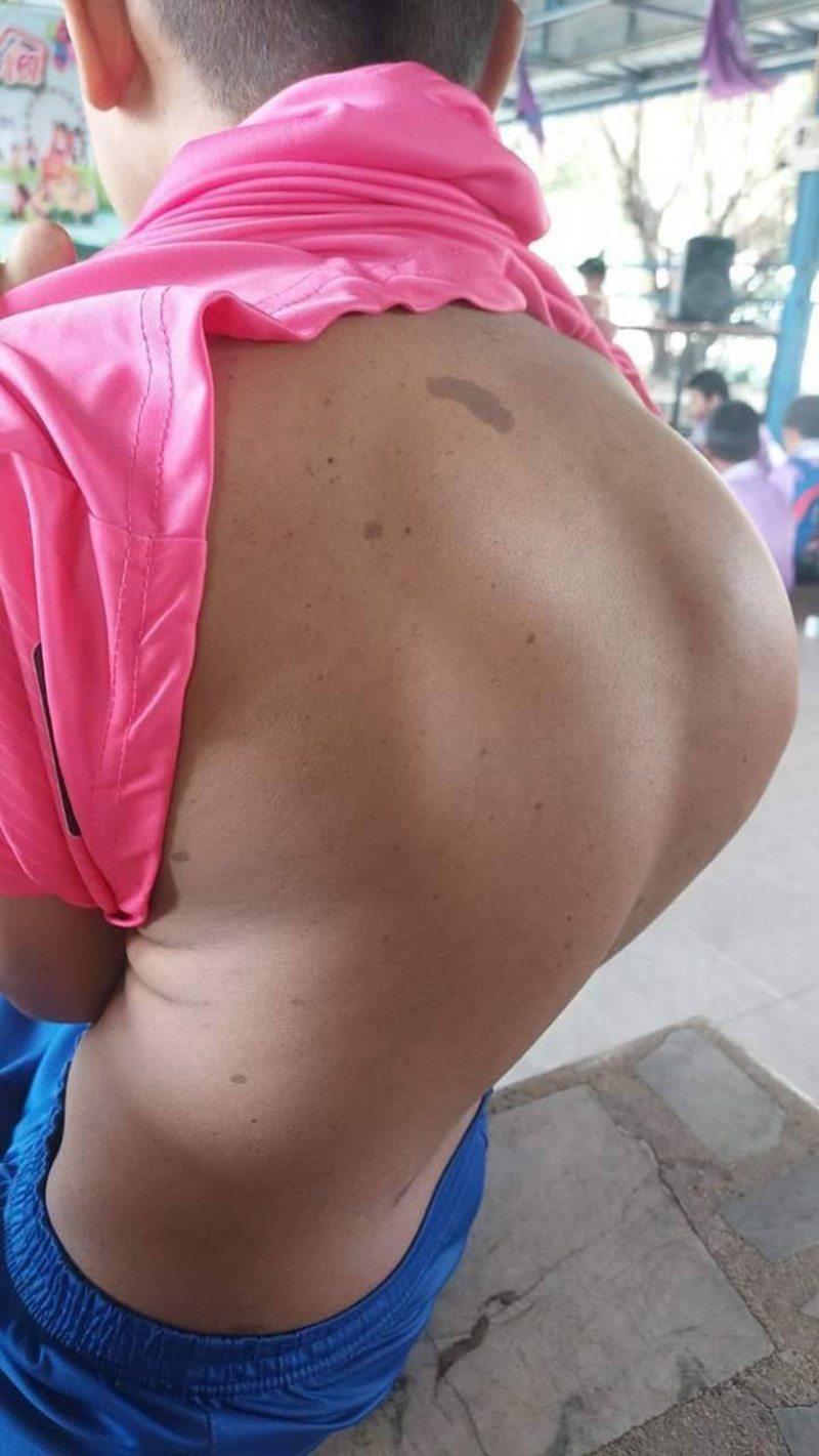 วอนช่วยลูกชายป่วยหลังคด กระดูกกดปอด ทับเส้นประสาท เสี่ยงตาบอด