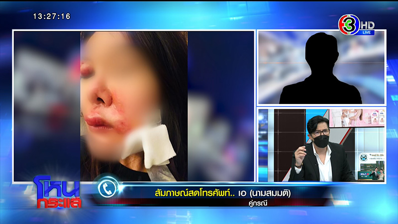 สาวโดนกัดหน้า VS แฟนเก่า