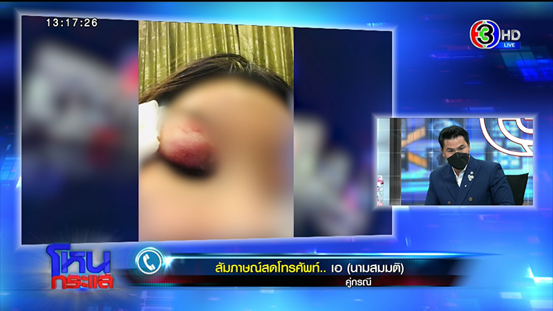 สาวโดนกัดหน้า VS แฟนเก่า