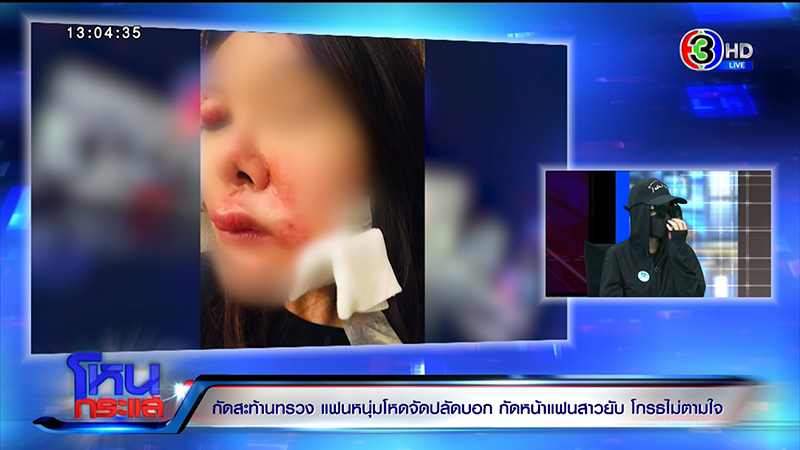 สาวโดนกัดหน้า VS แฟนเก่า