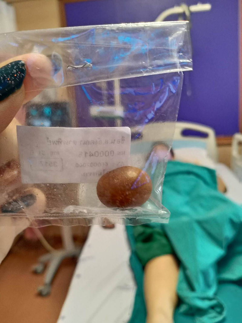 สาวปวดท้องบ่อย ตรวจทุกวิธีกว่าจะรู้สาเหตุ เจอทีมาเป็นลูก 