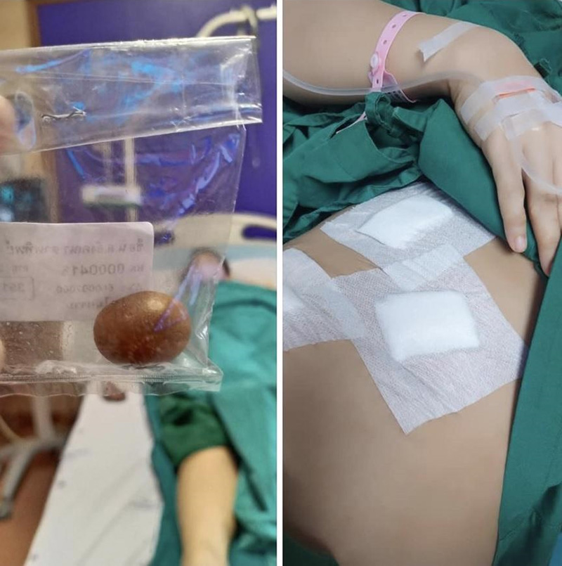 สาวปวดท้องบ่อย ตรวจทุกวิธีกว่าจะรู้สาเหตุ เจอทีมาเป็นลูก 