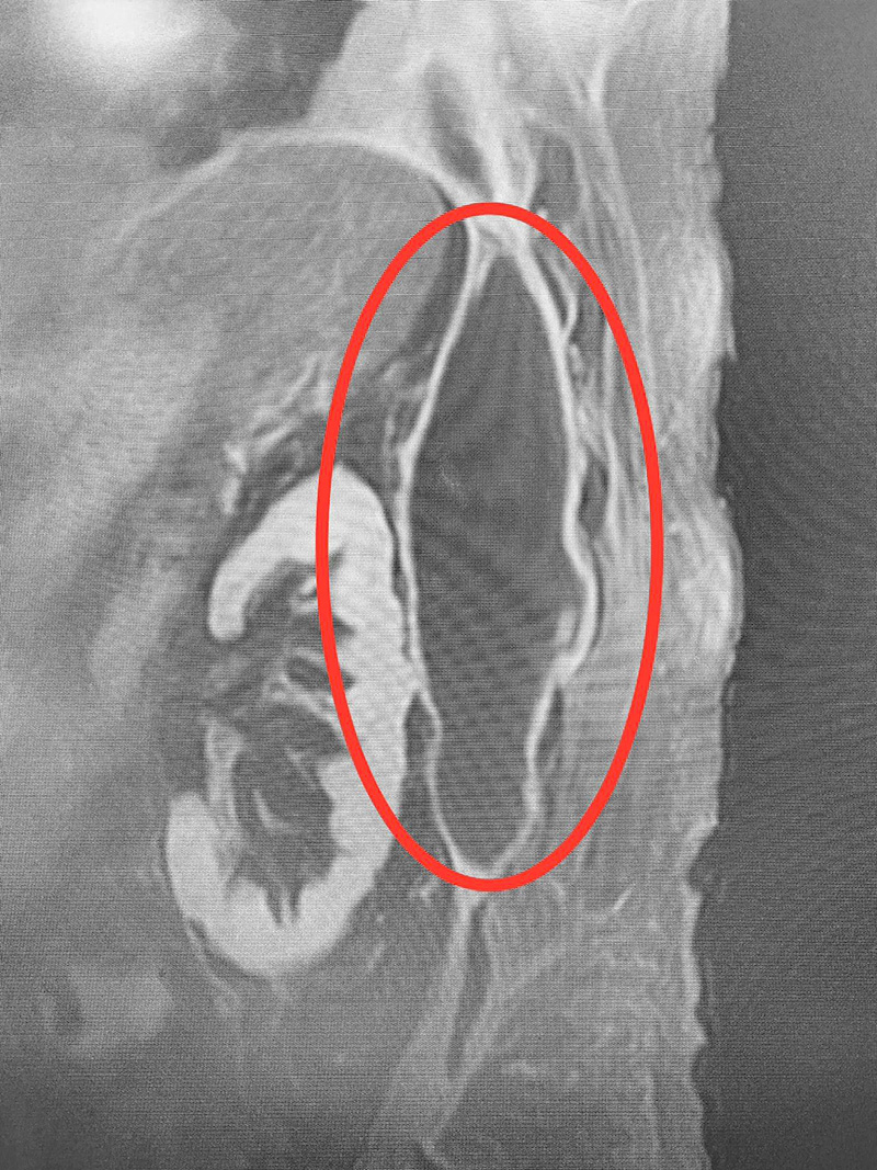 หมอเตือนปวดหลังบ่อย ปวดหลังเรื้อรัง สุดท้ายเจอมะเร็งก้อนยักษ์