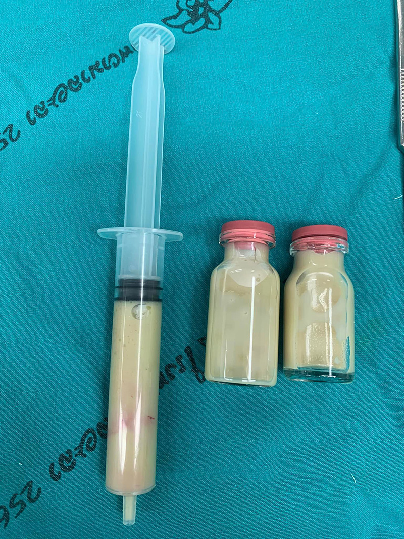 หมอเตือนปวดหลังบ่อย ปวดหลังเรื้อรัง สุดท้ายเจอมะเร็งก้อนยักษ์