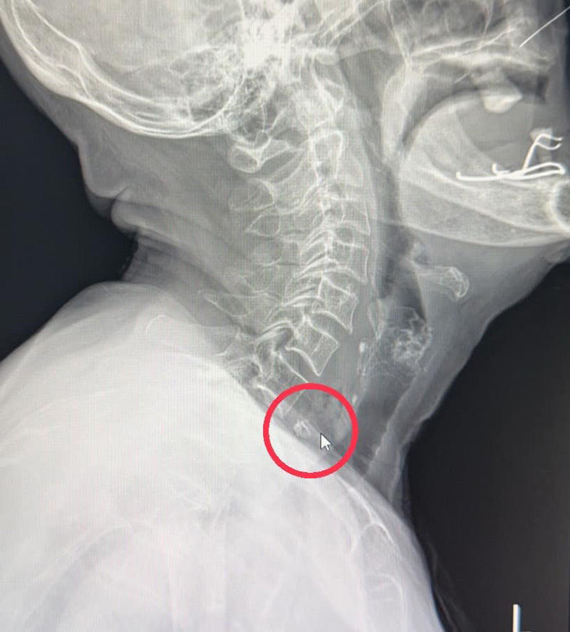 อุทาหรณ์ กินแกงนกสับจนติดคอ